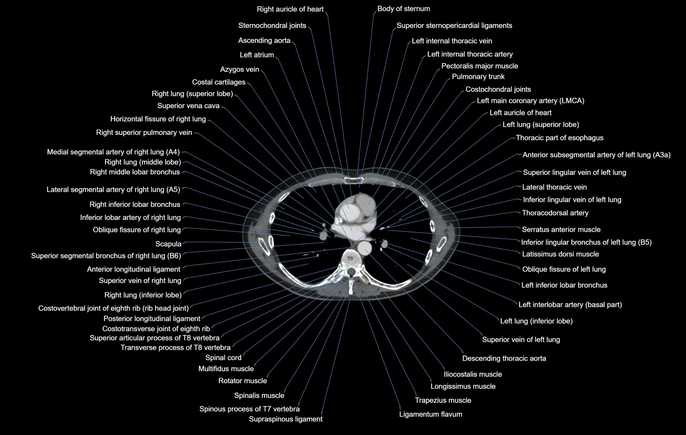 CT chest (thorax) soft tissue window labelled axial cross sectional anatomy radiology image-00064.webp